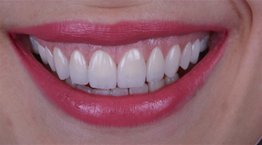 بعد تجميل وزراعةالاسنان فينير 7